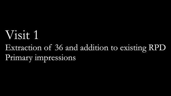 Finlay's Newsletter 59 Ultra hard partial dentures made for Gill