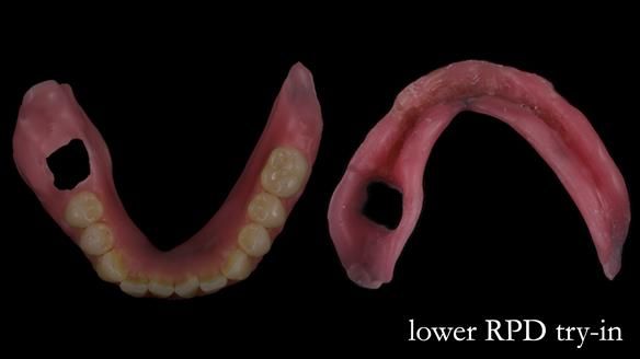 Newsletter 82 Mary - A complete upper and a one-tooth gasket denture