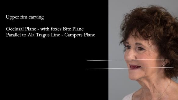 Newsletter 75: Marion’s case - Step-by-step complete denture workflow