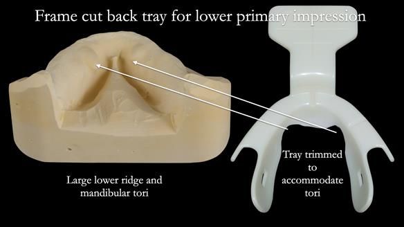 Newsletter 53 showing the making and fitting of ultra life-like dentures for Valena
