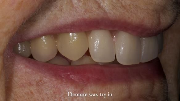 Newsletter 83: Sheila’s Complete Denture Success