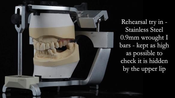 Newsletter 56 showing the making and fitting of a bilateral free end saddle upper removable partial denture (RPD) for patient with pemphigus