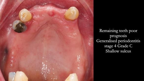 Finlay's Newsletter 59 Ultra hard partial dentures made for Gill