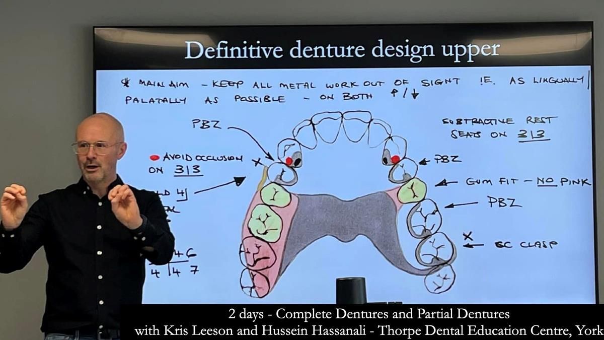 Finlay's Newsletter 59 Ultra hard partial dentures made for Gill