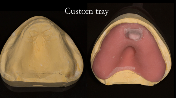 Figure 58 Primary cast and custom tray