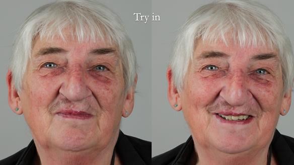 Newsletter 55 Provision of metal based partial dentures for Zephyrine with a repaired cleft lip and palate