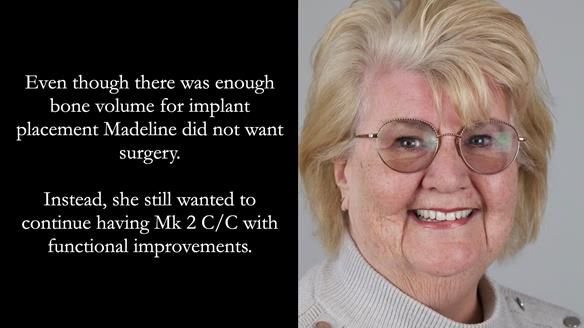 Replacing Madeline’s Complete denture FULL PROTOCOL