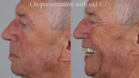 Newsletter 54 case presentation upper complete denture and lower Scandinavian designed hygienic partial denture for David