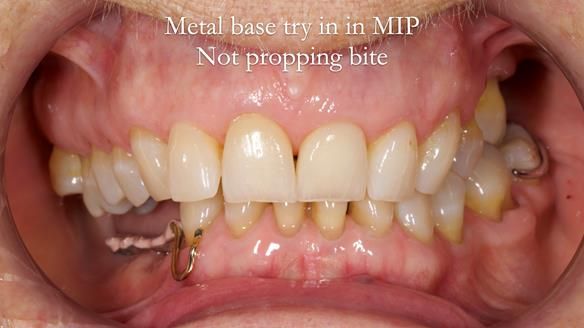 Finlay's Newsletter 61 provision of a lower unilateral free end saddle metal based partial denture for Joyce