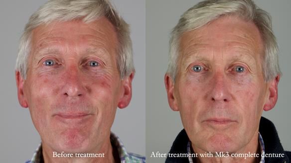 Newsletter 77: Jeremy’s case – immediate complete upper denture