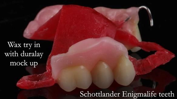 Finlay's Newsletter 60 Sylvia's upper Kennedy Class 2 Mod 1 metal based upper RPD