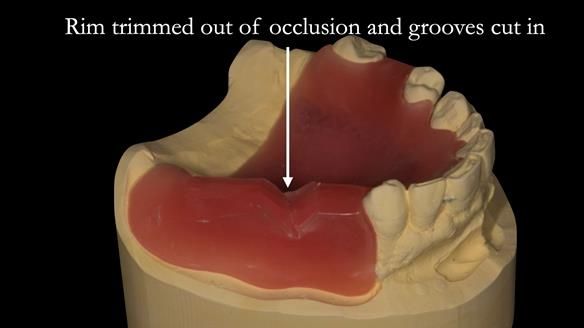 Finlay's Case Study Newsletter 40 - Immediate Mk 1 RPD to Definitive Mk 2 RPD - full protocol