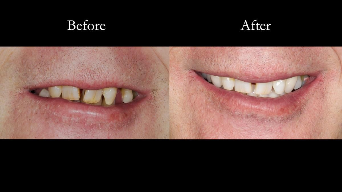 Newsletter 86 Peter the Architect — precision removable partial dentures case study