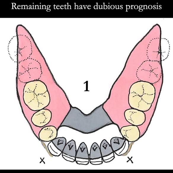 Universal Scandinavian partial denture designs