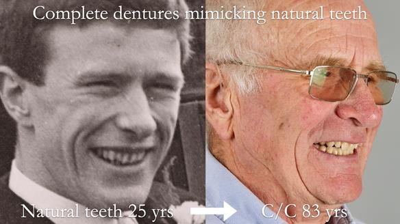 Complete denture Class II div 2 deep overbite Newsletter 39