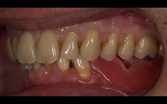 Figure 86 Visit 3 for Mk 2 fabrication. Inter-maxillary record of the maxillary Mk 1 denture. This allowed a copy of the Mk 1 to be mounted on the articulator to allow the Mk 2 denture to mimic the tooth arrangement. The patient was happy with the aesthet