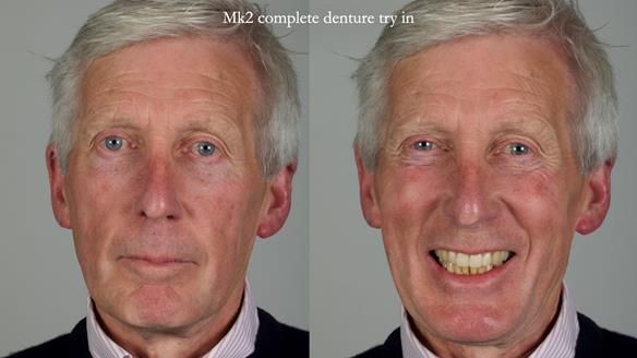 Newsletter 77: Jeremy’s case – immediate complete upper denture