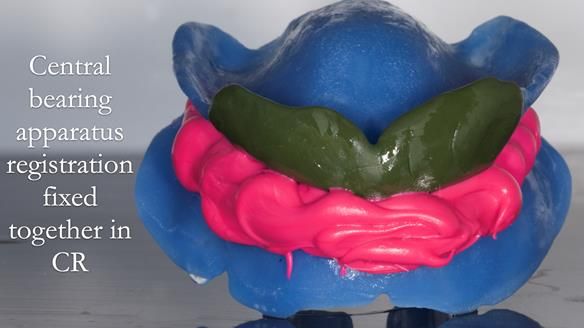 Newsletter 53 showing the making and fitting of ultra life-like dentures for Valena