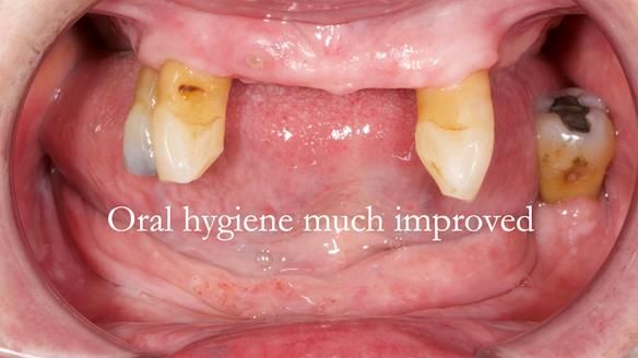 Finlay's Newsletter 59 Ultra hard partial dentures made for Gill