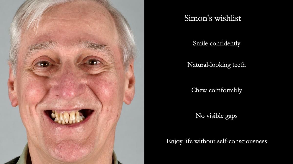 Newsletter 89 – Simon: A Challenging Kennedy Class II Division 1 Upper CoCr Partial Denture with a High Smile Line