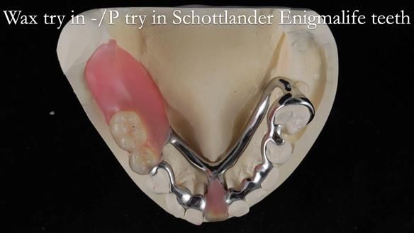 Newsletter 54 case presentation upper complete denture and lower Scandinavian designed hygienic partial denture for David