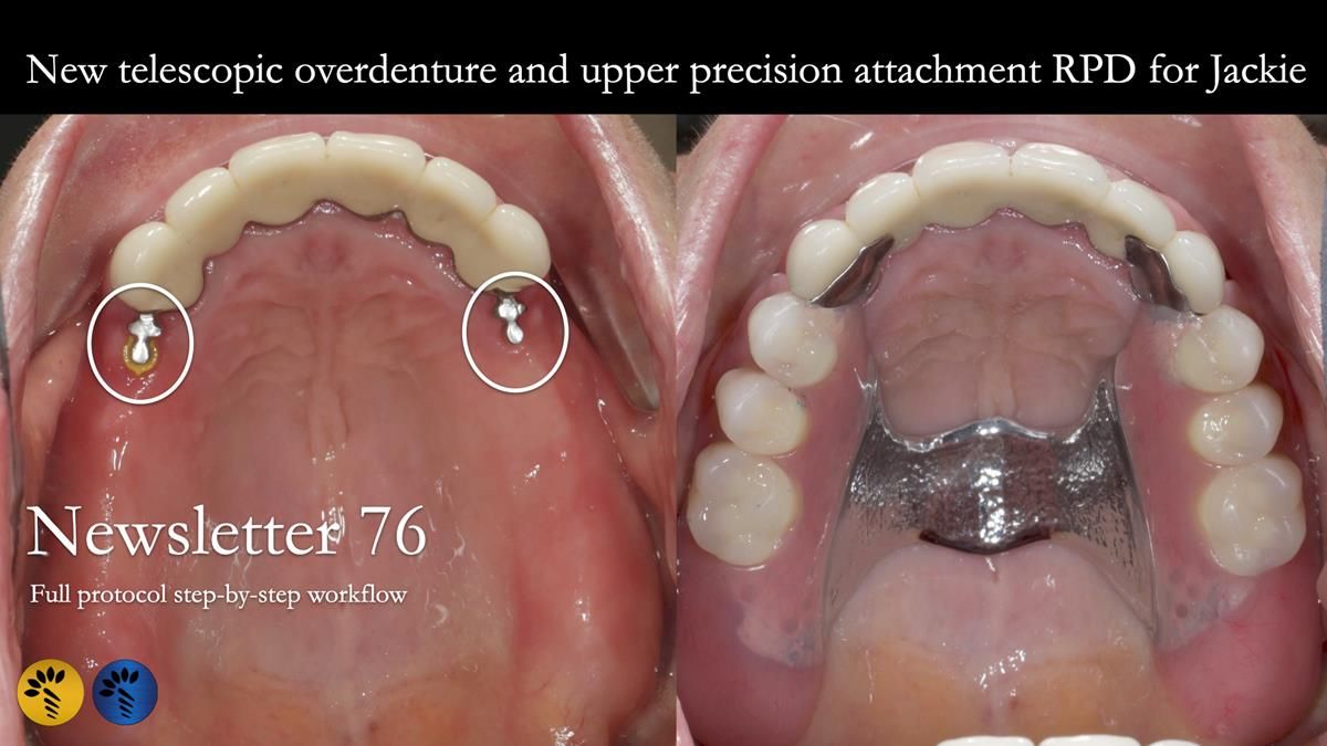 Newsletter 76: Jackie’s case – Telescopic overdenture & precision RPD (the tricky truth!)