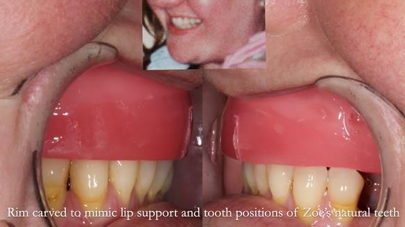Finlay's Newsletter 58 Gasket upper partial denture for Zoe