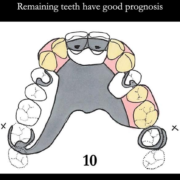 Universal Scandinavian partial denture designs