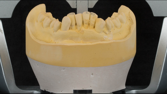 Figure 21 Mounted working lower cast for Mk 1 immediate denture. - showing overerupted teeth