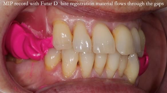 Newsletter 56 showing the making and fitting of a bilateral free end saddle upper removable partial denture (RPD) for patient with pemphigus