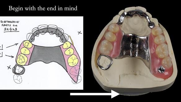 Finlay's Newsletter 60 Sylvia's upper Kennedy Class 2 Mod 1 metal based upper RPD