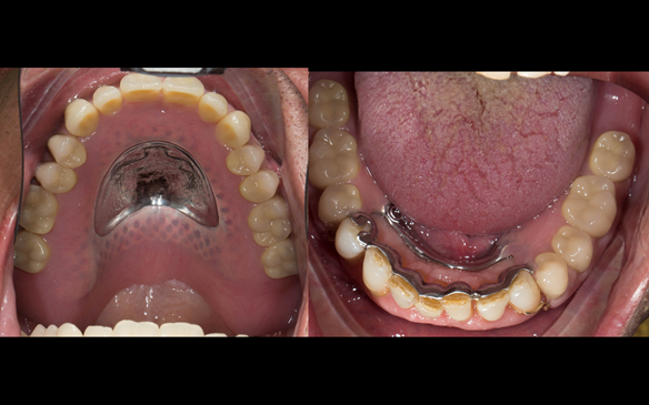 Figure 118 Mk 2 finished dentures fitted
