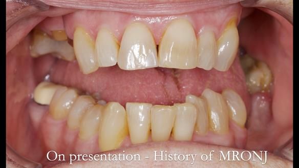 Finlay's Newsletter 60 Sylvia's upper Kennedy Class 2 Mod 1 metal based upper RPD