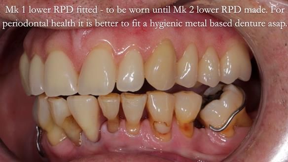 Newsletter 54 case presentation upper complete denture and lower Scandinavian designed hygienic partial denture for David