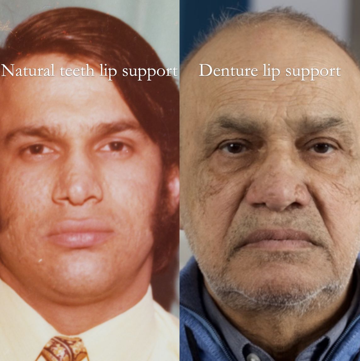 No photographs available showing natural teeth