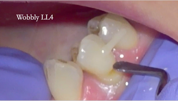 Figure 60 Grade 2 mobile LR4 would move in the impression. To avoid this it was temporarily stabilised with a composite splint