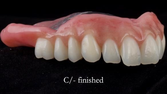 Managing poor implant positioning with complete dentures and Locator attachments - full protocol Newsletter 41
