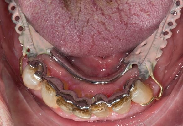 Figure 99 Cobalt chromium framework trial insertion in the mouth. The lingual bar does not rest on the soft tissues - blocked by a wash of wax less than 0.5mm thick