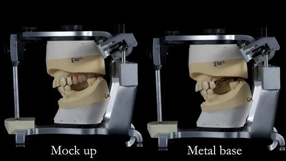Newsletter 56 showing the making and fitting of a bilateral free end saddle upper removable partial denture (RPD) for patient with pemphigus