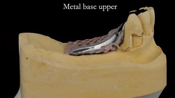 Finlay's Case Study Newsletter 40 - Immediate Mk 1 RPD to Definitive Mk 2 RPD - full protocol