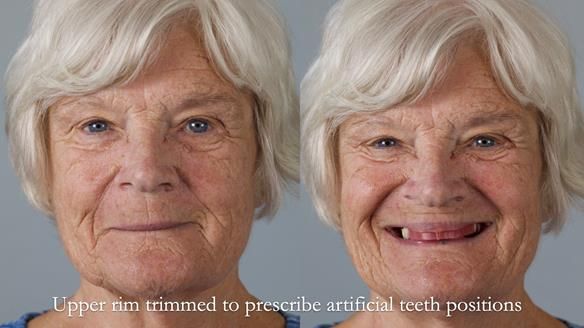 Eileen's transformation with upper and lower RPDs of Scandinavian hygienic design FULL PROTOCOL