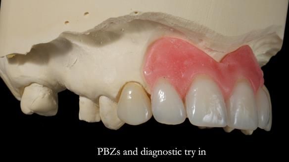 Newsletter 81 - Pam’s Story — how a partial denture changed her life (+ live walkthrough this Thursday)