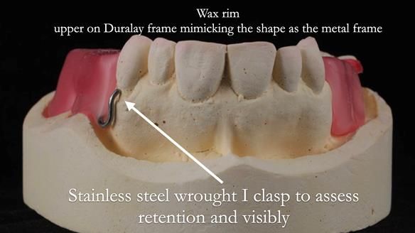 Finlay's Newsletter 60 Sylvia's upper Kennedy Class 2 Mod 1 metal based upper RPD