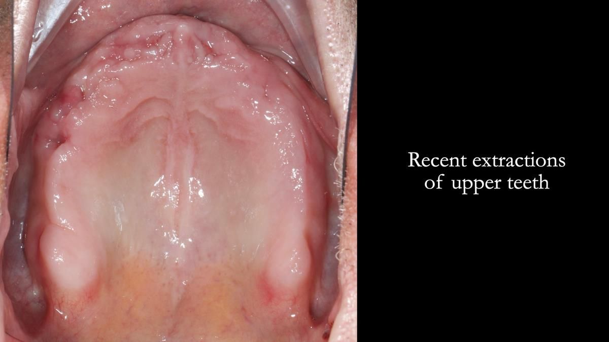 Fin’s Newsletter 88 — Complete dentures - full protocol… he rearranged his own teeth!