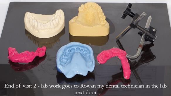 Finlay's Newsletter 64 case study - provision of a Kennedy class 2 metal based Scandinavian RPD for Ian