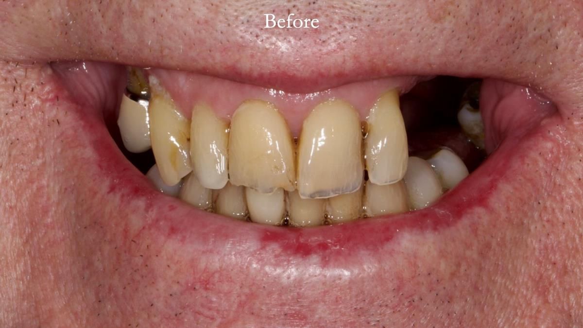 Newsletter 89 – Simon: A Challenging Kennedy Class II Division 1 Upper CoCr Partial Denture with a High Smile Line