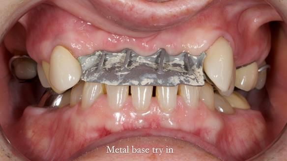 Newsletter 81 - Pam’s Story — how a partial denture changed her life (+ live walkthrough this Thursday)