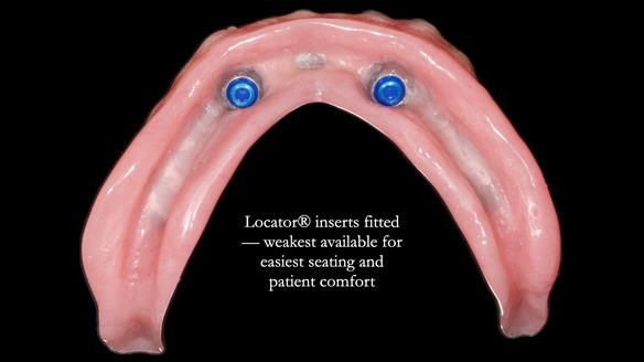 Newsletter 78: What do Clark Gable and a Locator® overdenture have in common?