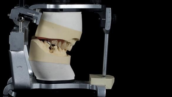 Newsletter 86 Peter the Architect — precision removable partial dentures case study