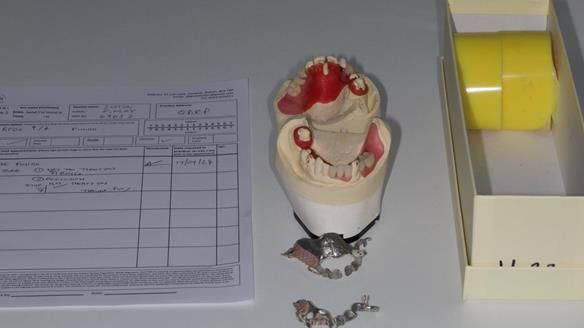 Newsletter 86 Peter the Architect — precision removable partial dentures case study